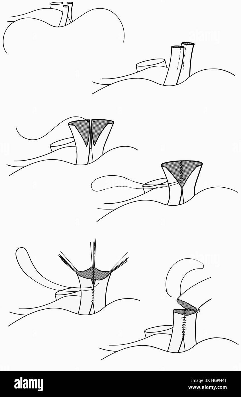 - Chirurgie de l'artère coronaire anormale Technique de Réparation. Deux artères coronaires anomale couture ensemble comme une paire de pantalons pour créer une artère viables Banque D'Images