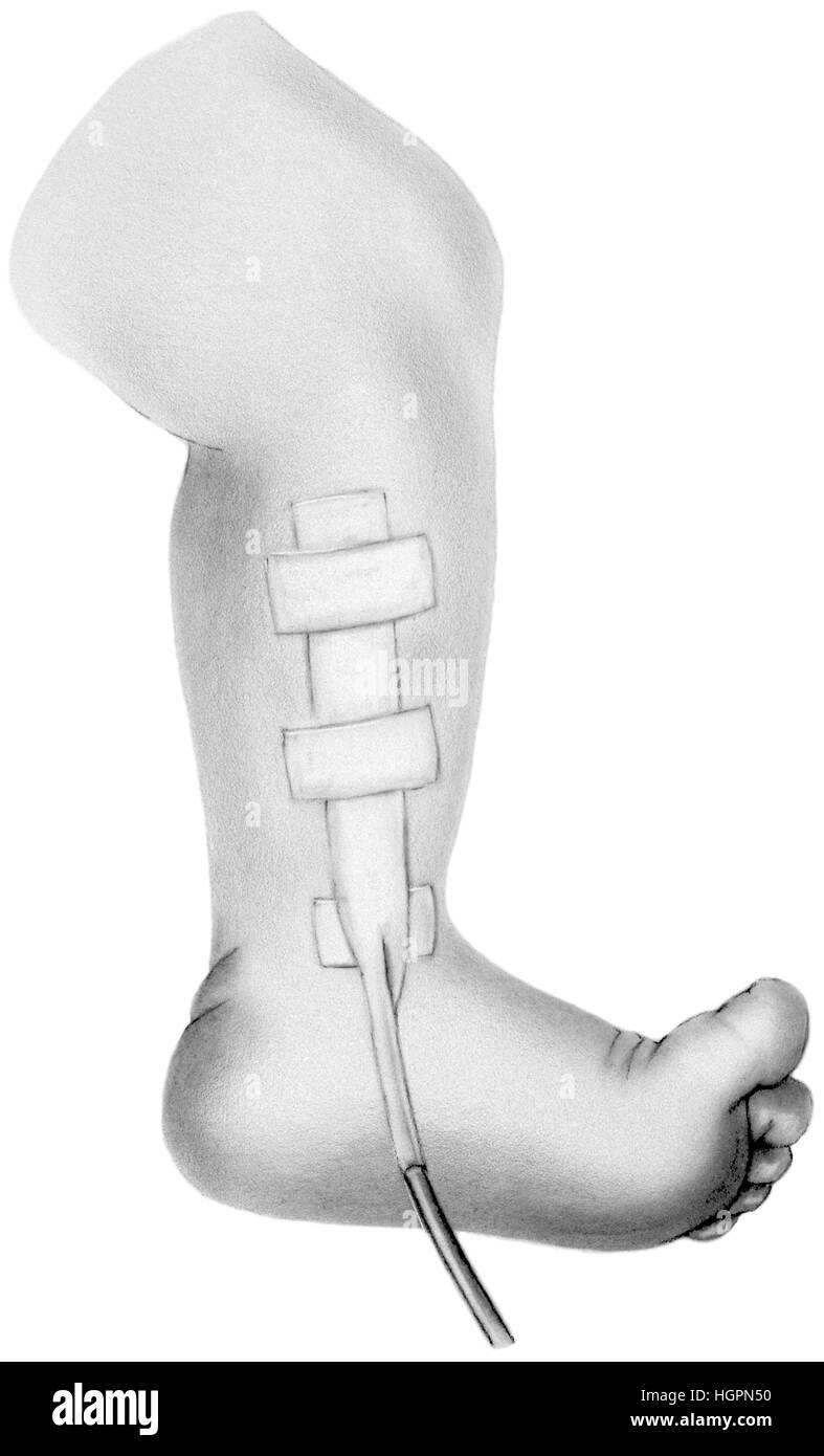 Drain chirurgical de l'enfant - partie inférieure de la jambe et du pied  Photo Stock - Alamy