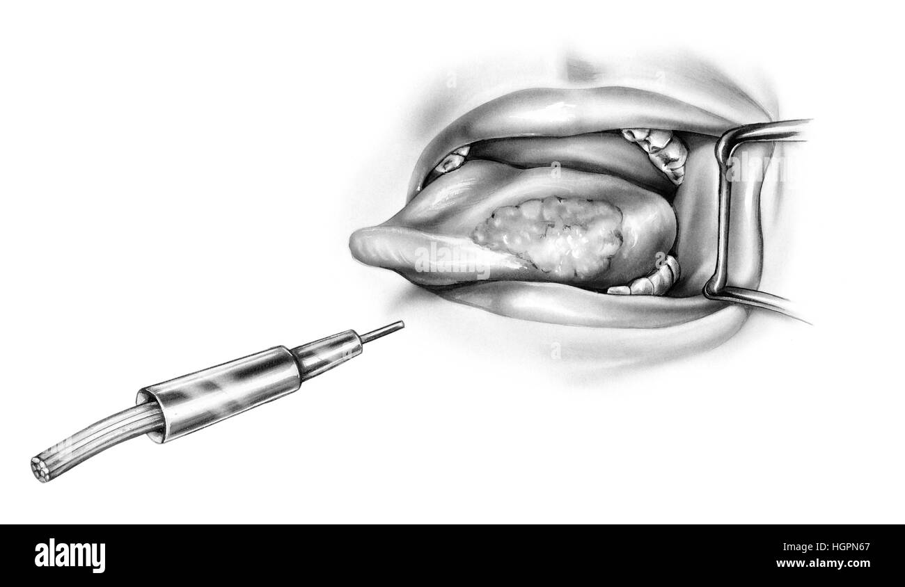 Langue maternelle - Le cancer Le traitement au laser Banque D'Images