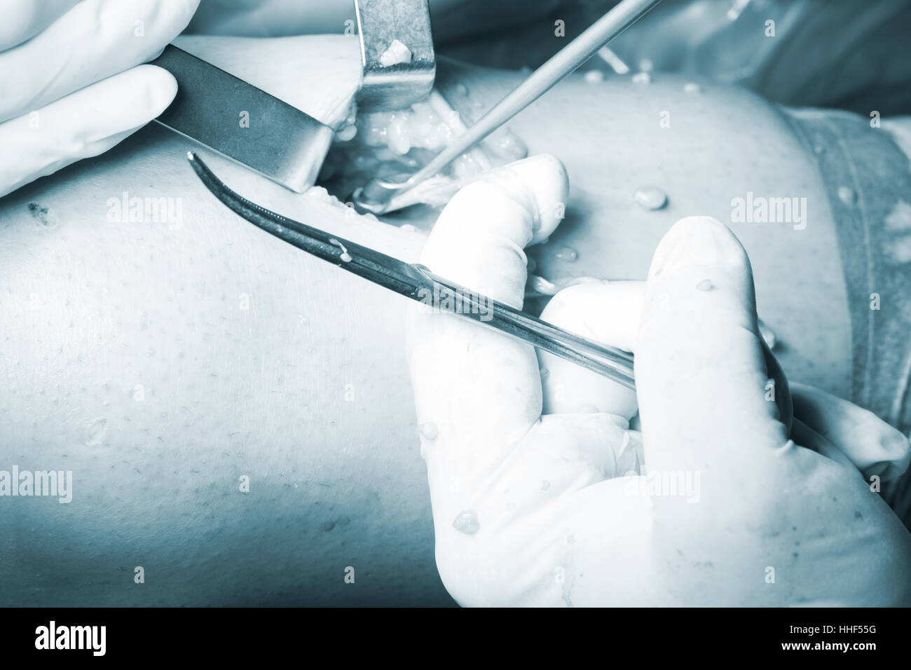 Opération chirurgicale l