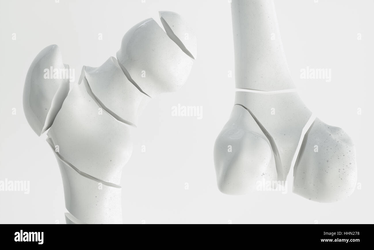 Fracture du fémur - Rendu 3D - Arrêt Banque D'Images