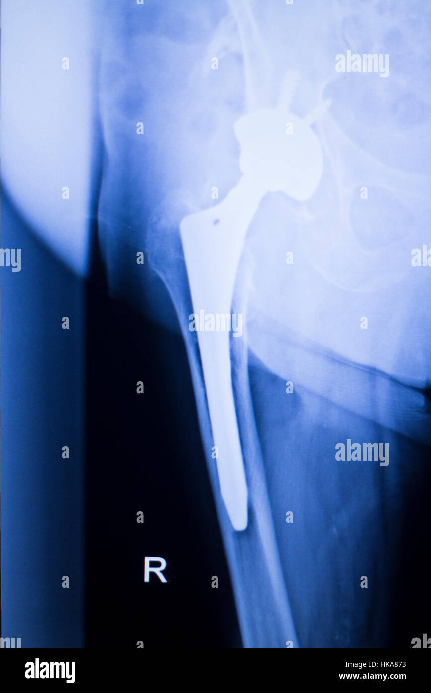 Remplacement de l'articulation de la hanche xray montrant joint à