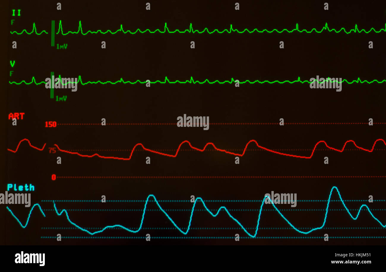 Moniteur avec écran noir montrant le flutter auriculaire avec EKG lignes vertes sur la pression artérielle, sur la ligne rouge et la saturation en oxygène sur la ligne bleue, Banque D'Images