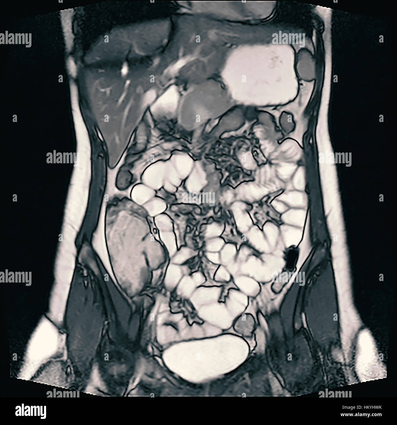 Entérographie également appelée étude gastro-intestinaux ou contraste radiographie de l'appareil digestif, est une série de radiographies utilisée pour examiner t Banque D'Images