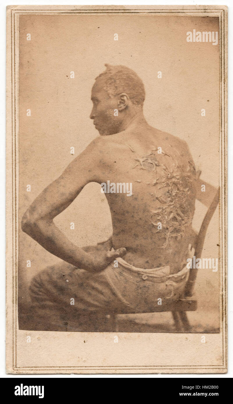 Cette célèbre photographie de 1863, connue sous le nom de « Scourged Back », représente le dos d'un esclave, montrant les cicatrices d'une punition brutale. Il a été pris dans le cadre d'une étude historique sur l'esclavage et son impact physique et émotionnel. Banque D'Images