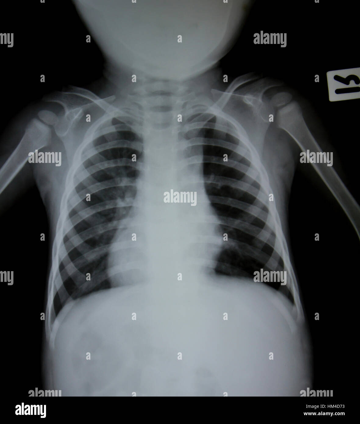 Chest X Ray Children Banque De Photographies Et D images Haute chest-x-ray-children-banque-de-photographies-et-d-images-haute