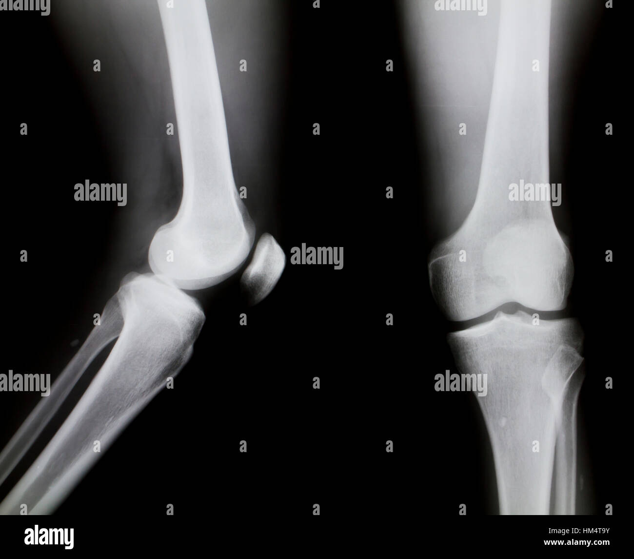 X-ray de genou (genou normal) Banque D'Images