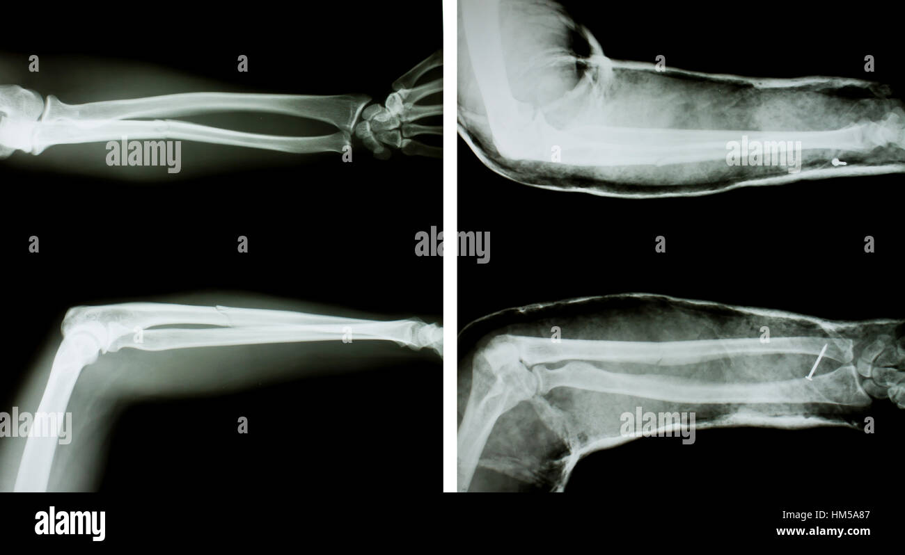 X-ray des deux bras humain normal (armes et armes avec attelle). Banque D'Images