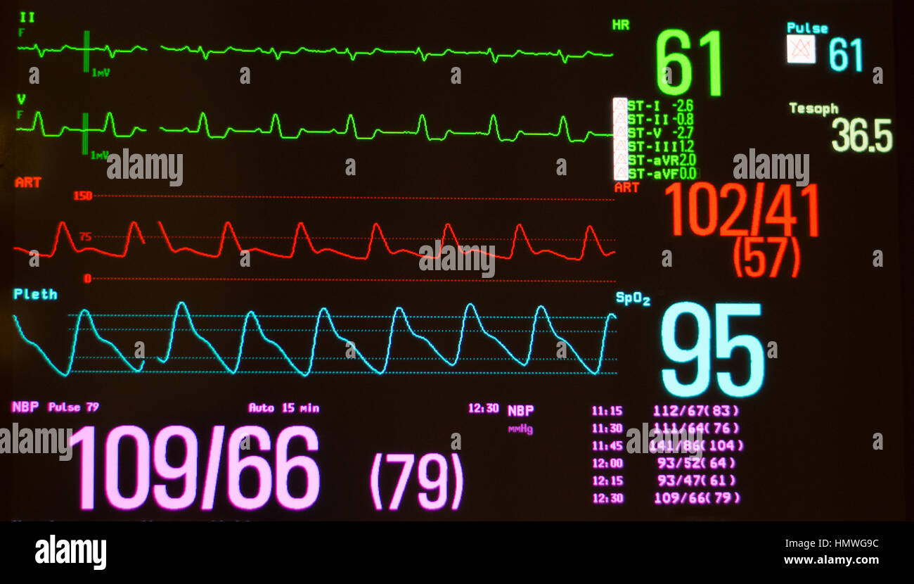Retard de conduction sur Intraventriular sur EKG lignes vertes, notamment la pression artérielle sur la ligne rouge et l'oxygène saturaltion plethsmography, sur la ligne bleue. Banque D'Images