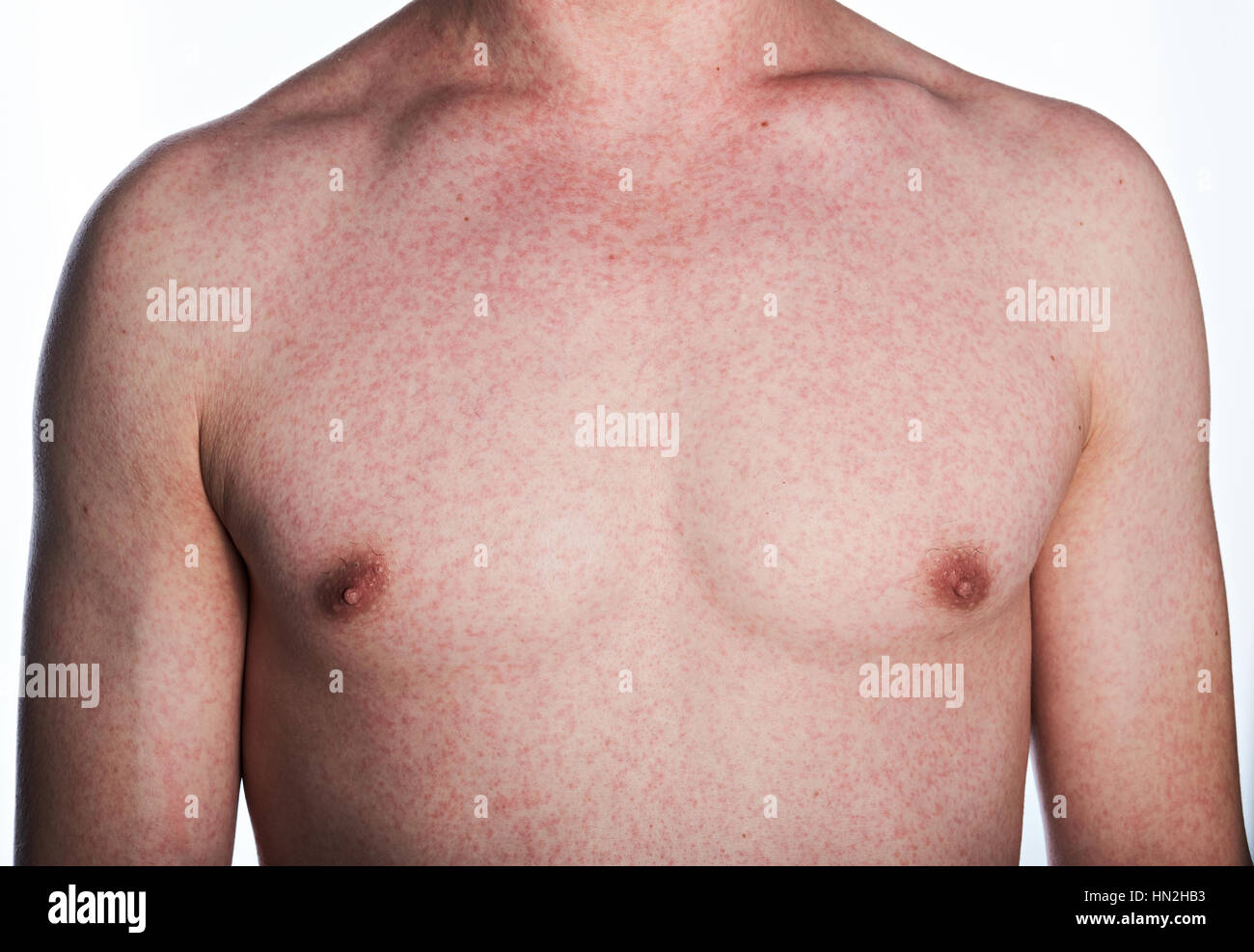 Réaction allergique sur la peau de la poitrine de l'homme Photo ...