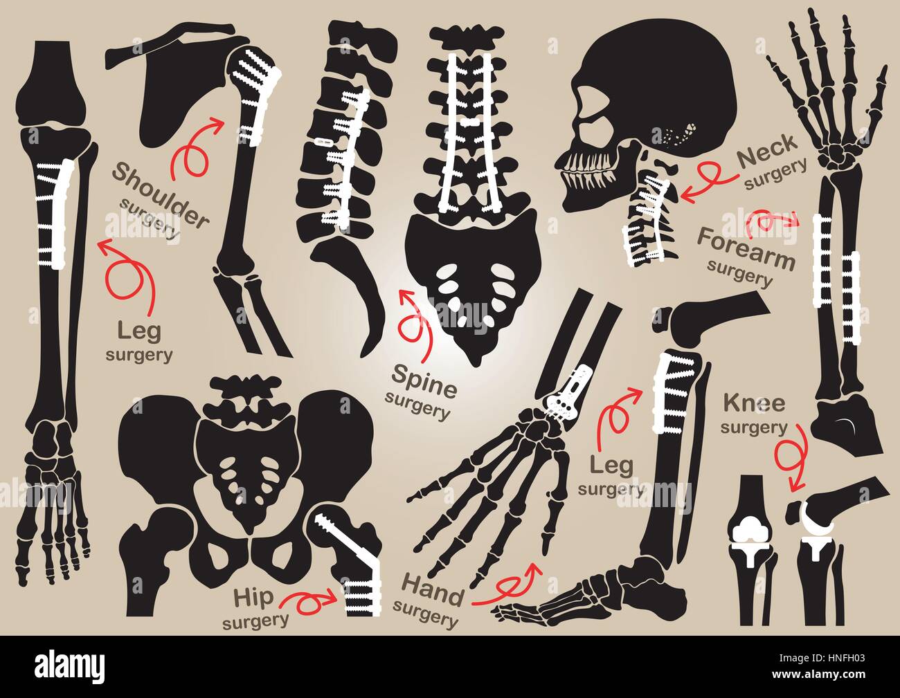 Collection de chirurgie orthopédique ( la fixation interne par plaque et vis )( crâne , tête , cou , colonne vertébrale sacrum , bras , , , main , l'avant-bras Coude ,devrait Illustration de Vecteur