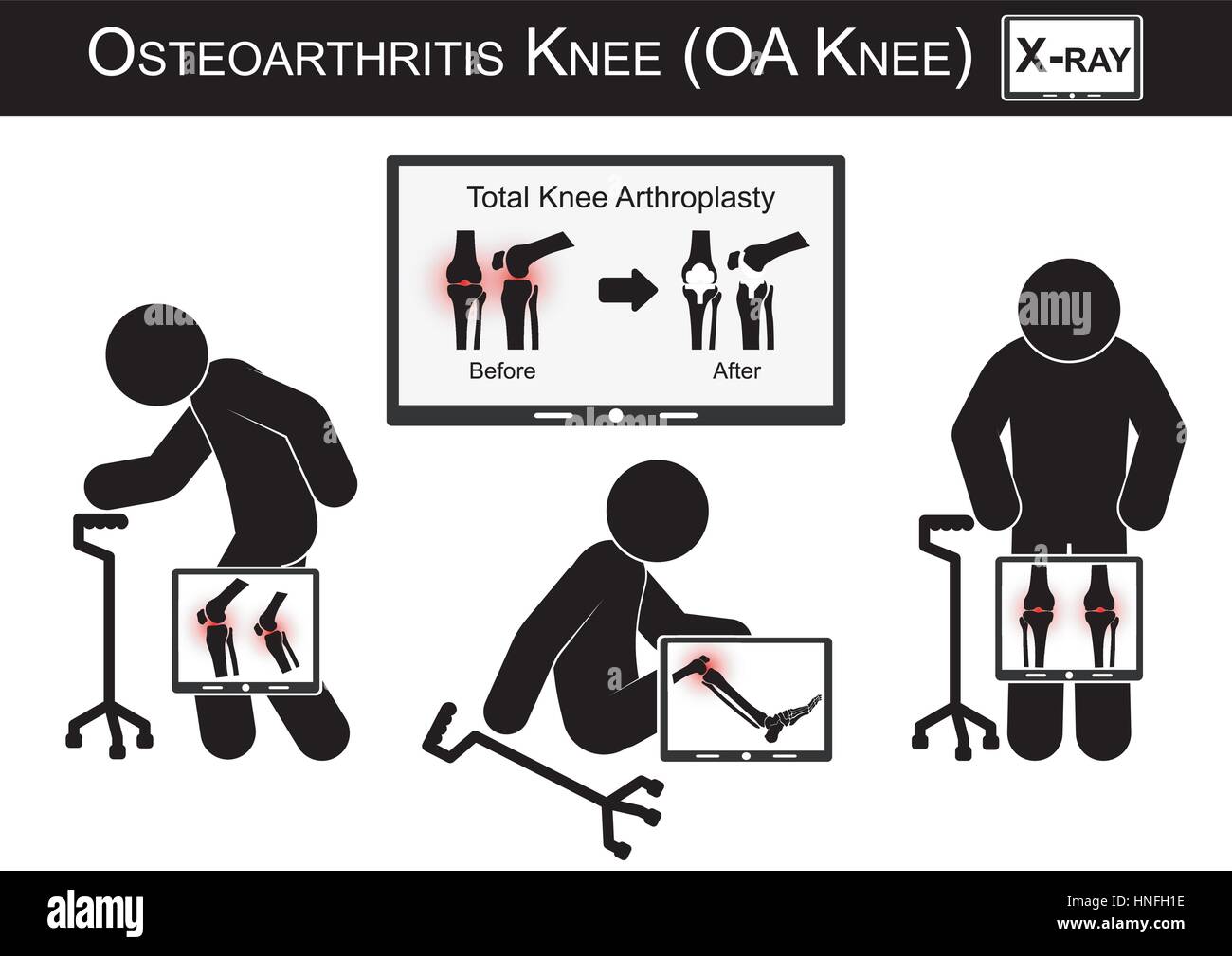 Vieil homme la douleur à son genou , Moniteur show image d'arthroplastie totale du genou ( avant et après traitement chirurgical ) arthrose vector ( télévision des Illustration de Vecteur