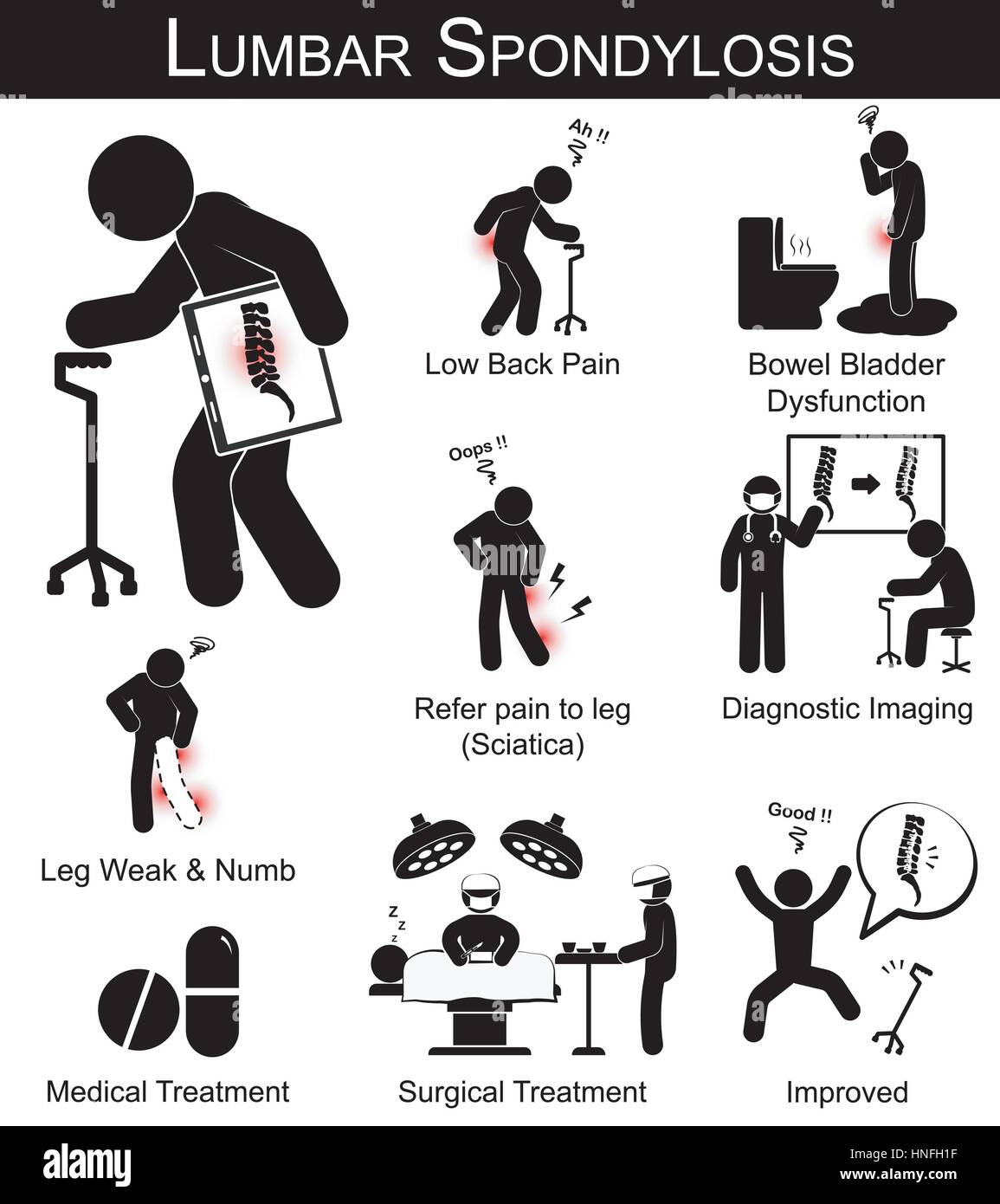 La Spondylose lombaire pictogramme ( les symptômes des douleurs au bas du  dos , reportez-vous à la douleur et l'engourdissement de la jambe , jambes  , la faiblesse de la vessie intestin