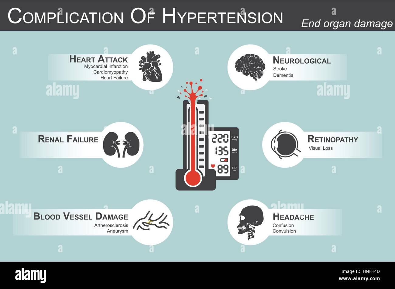 Complication de l'Hypertension(Crise cardiaque infarctus du myocarde : cardiomyopathie , )(Cerveau : cp , démence )( perte visuelle )(maux)(rénal failur Illustration de Vecteur