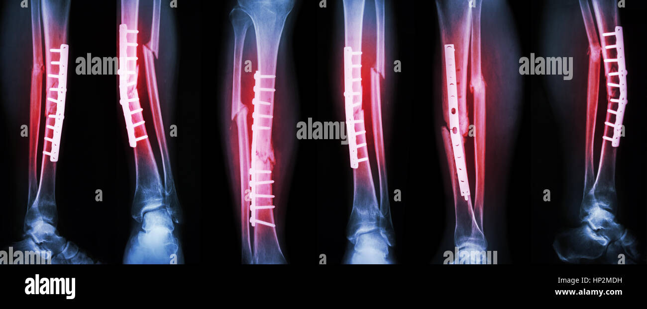 Collection image de fracture de la jambe et un traitement chirurgical par la fixation interne avec la plaque et vis . Briser l'os du tibia et du péroné . Banque D'Images