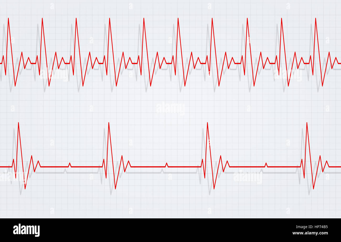 Rythme Cardiaque Lent