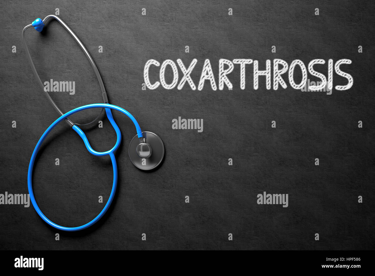 Coxarthrose : concept médical à la main sur tableau noir. Coxarthrose : concept médical à la main sur tableau noir. Vue de dessus de Stethos bleu Banque D'Images