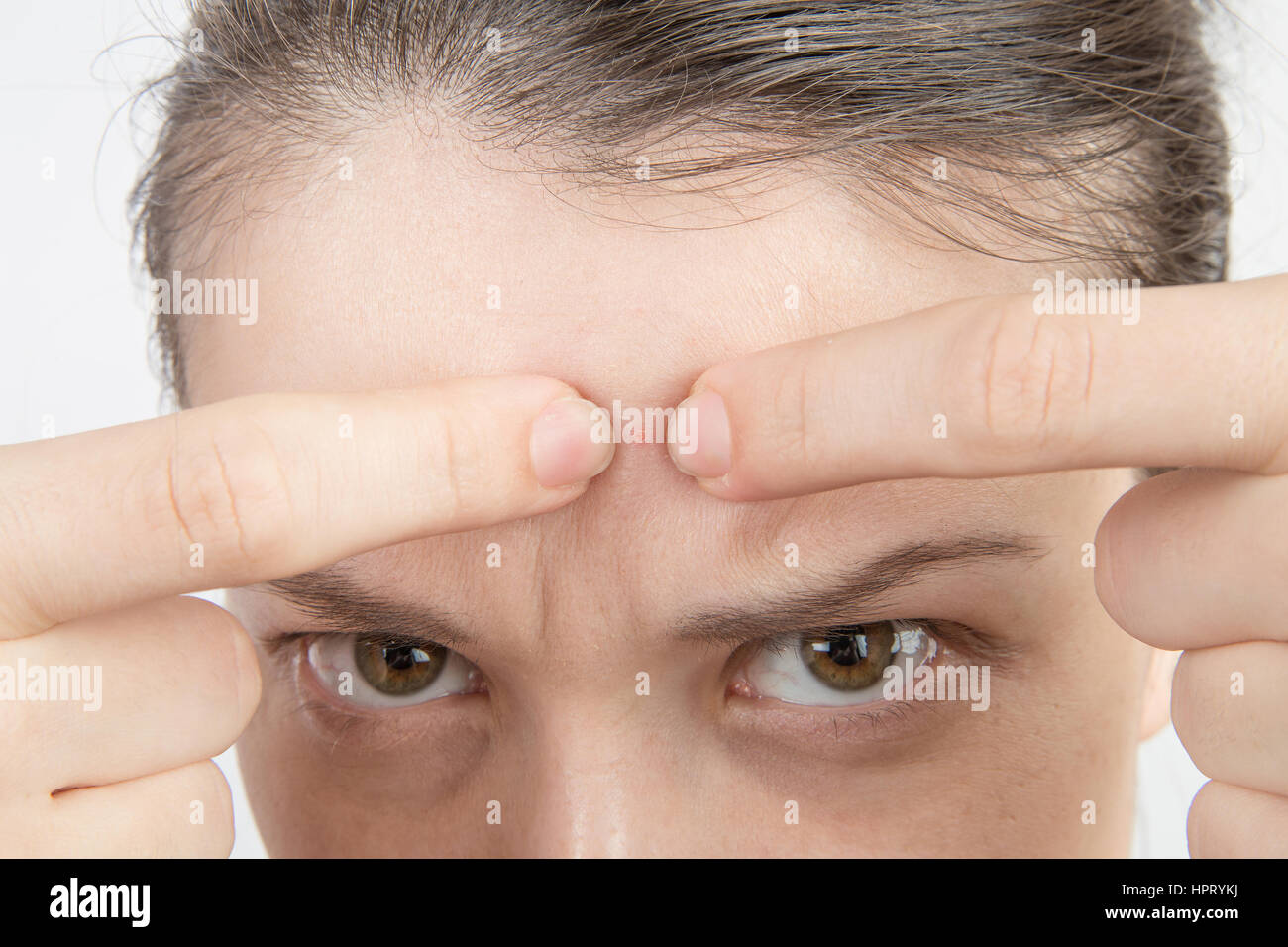 Jeune fille avec des problèmes de peau acné sur le visage close up Banque D'Images