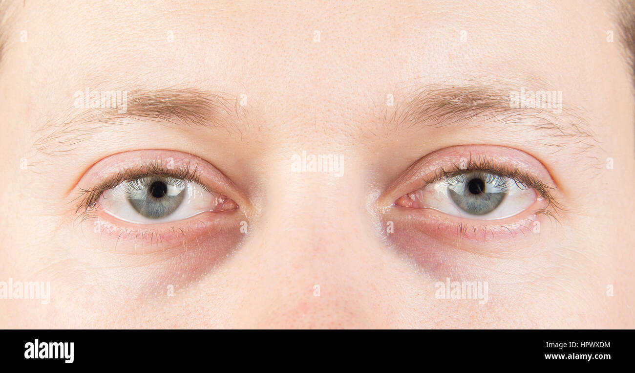 Les yeux gris de l'homme fatigué close up Banque D'Images