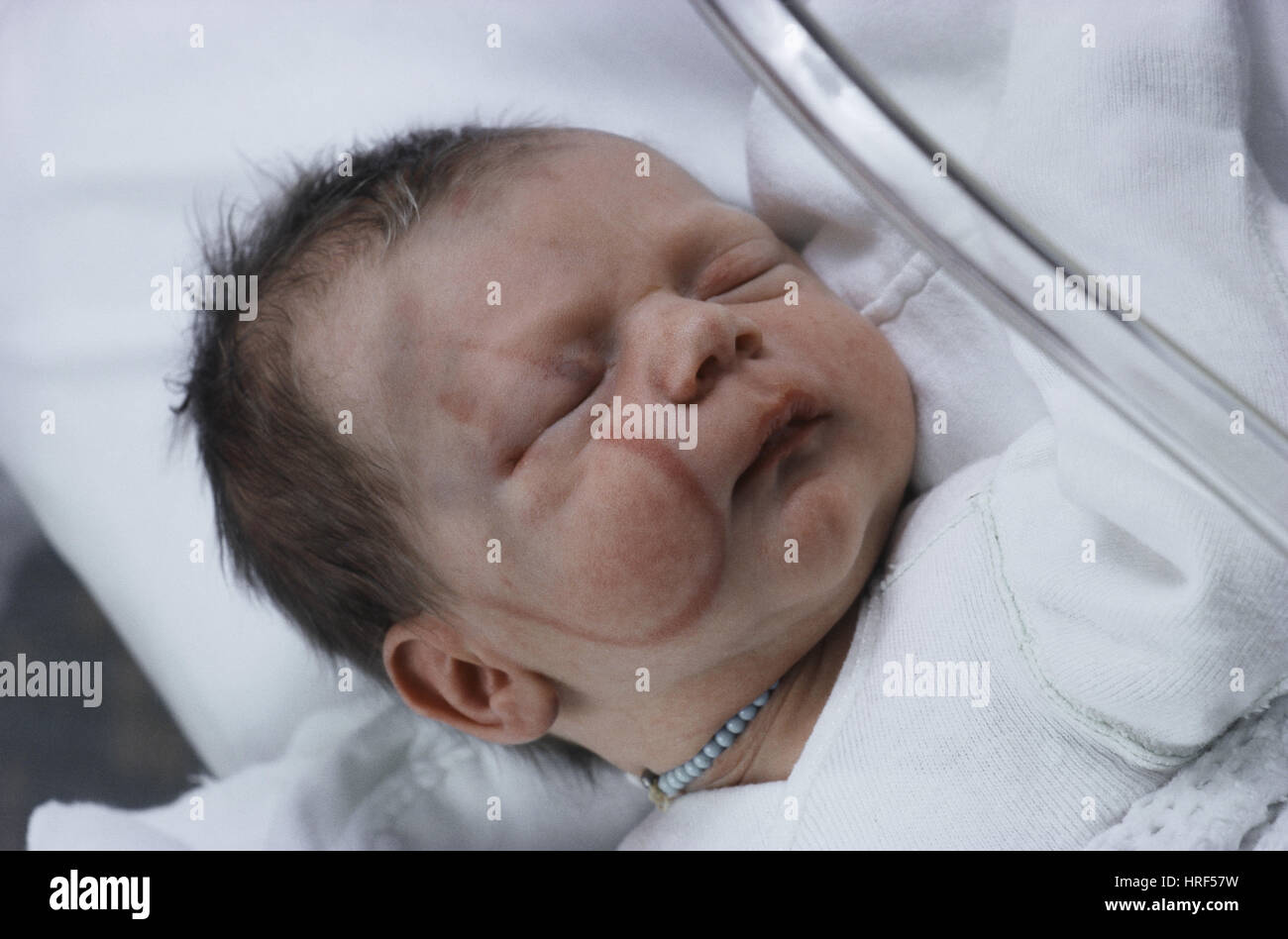 Mark Forceps Sur Le Visage Bebe Nouveau Ne Photo Stock Alamy Mark Forceps Sur Le Visage Bebe Nouveau Ne Photo Stock Alamy