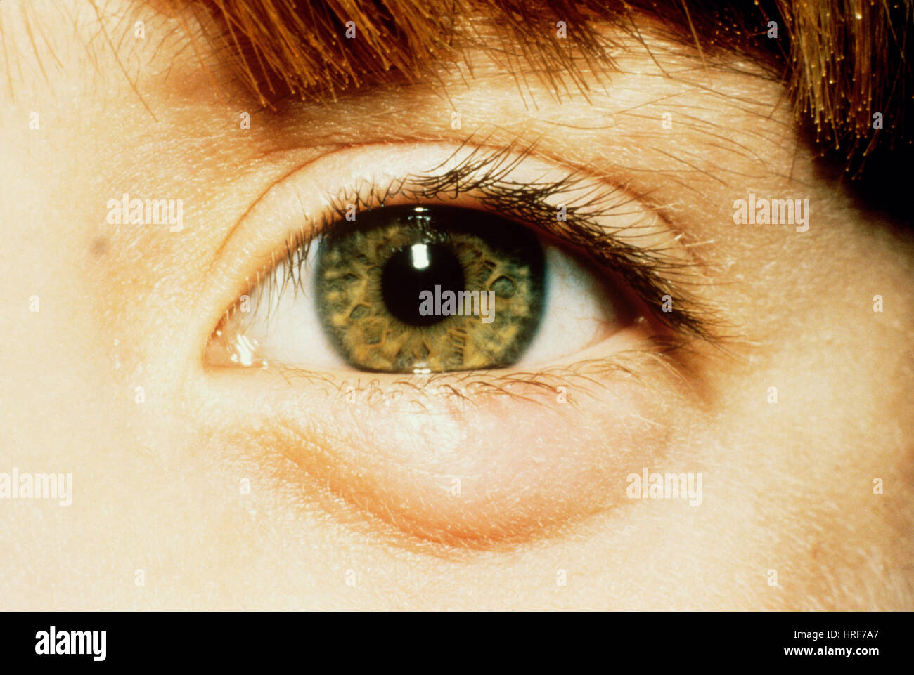 Lipogranulome de la glande de meibomius Banque de photographies et d ...