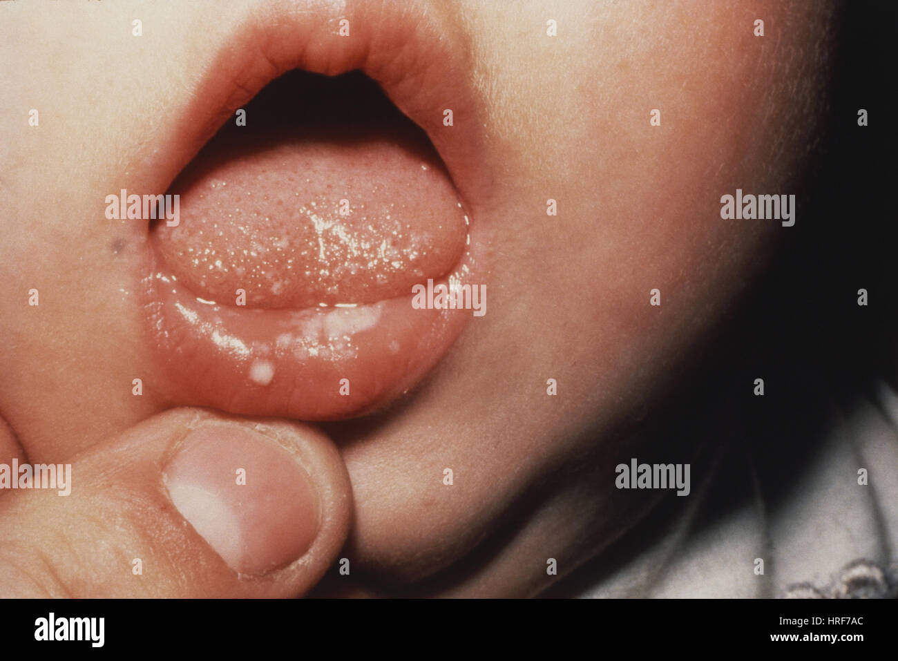 La Candidose Orale Photo Stock Alamy La Candidose Orale Photo Stock Alamy