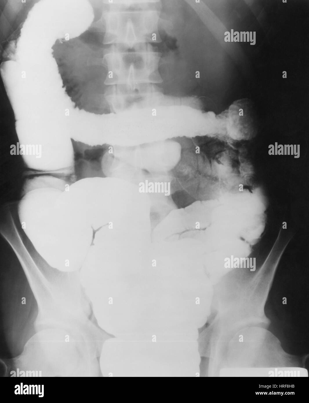 X-ray de moelle épinière montrant la rectocolite hémorragique Banque D'Images