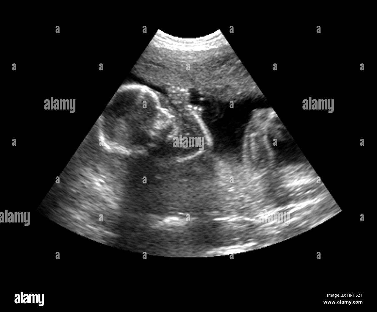 Echographie 3d Banque D Images Noir Et Blanc Alamy