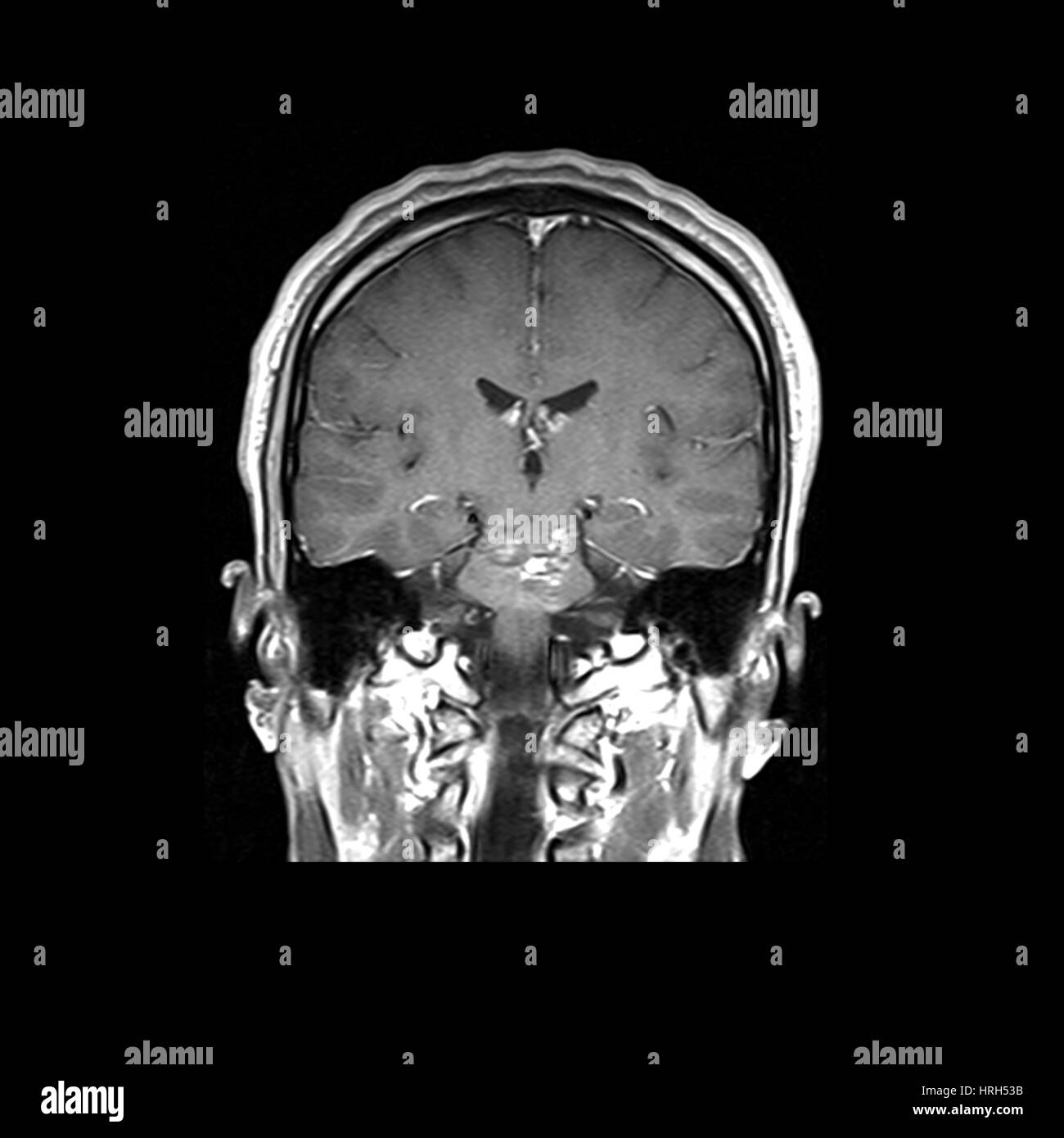 Malformations caverneuses du tronc cérébral IRM Banque D'Images