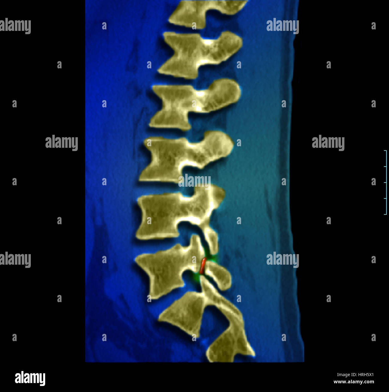 Spondylolyse Banque D'Images