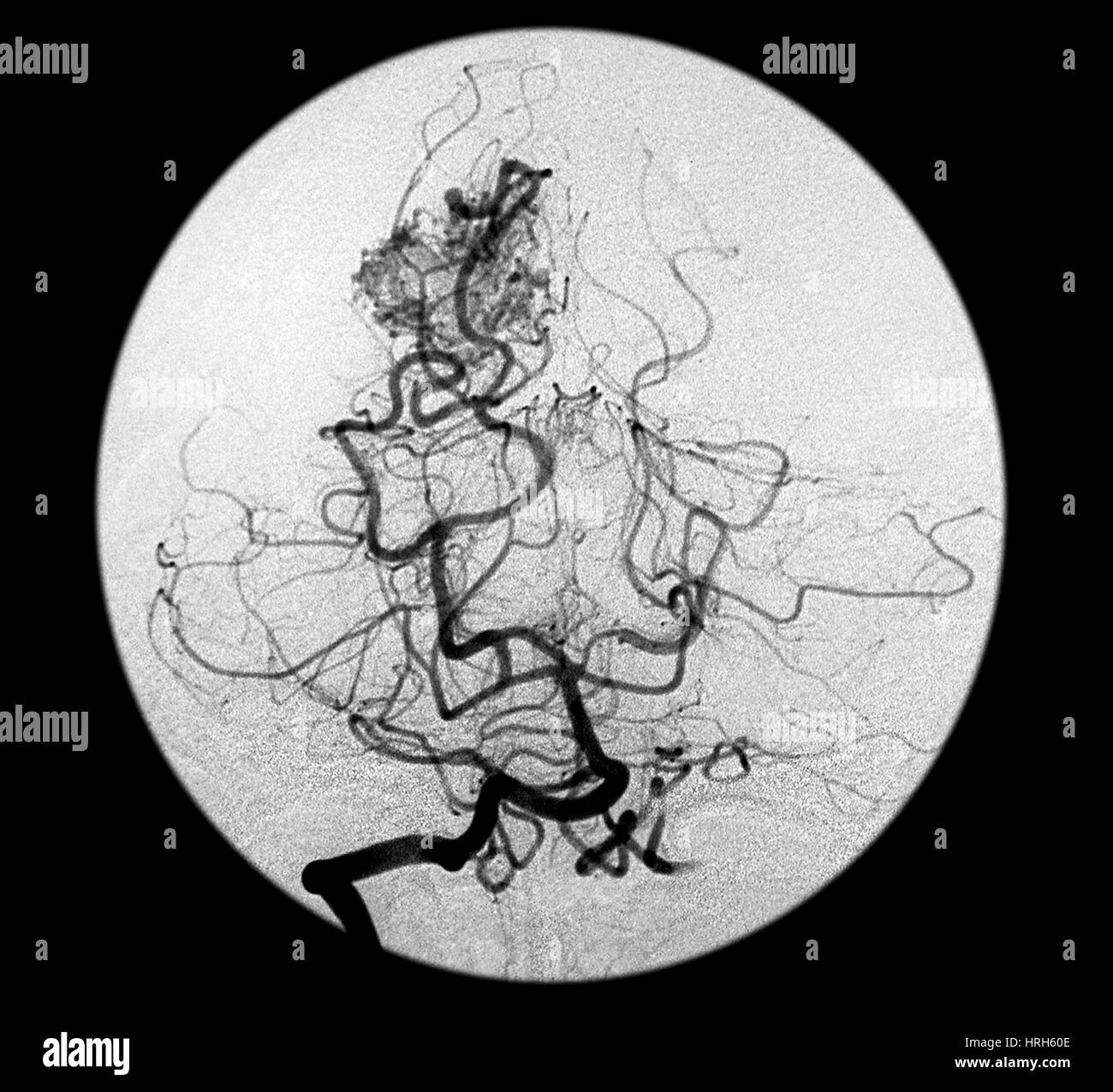 Lobe occipital AVM Banque D'Images