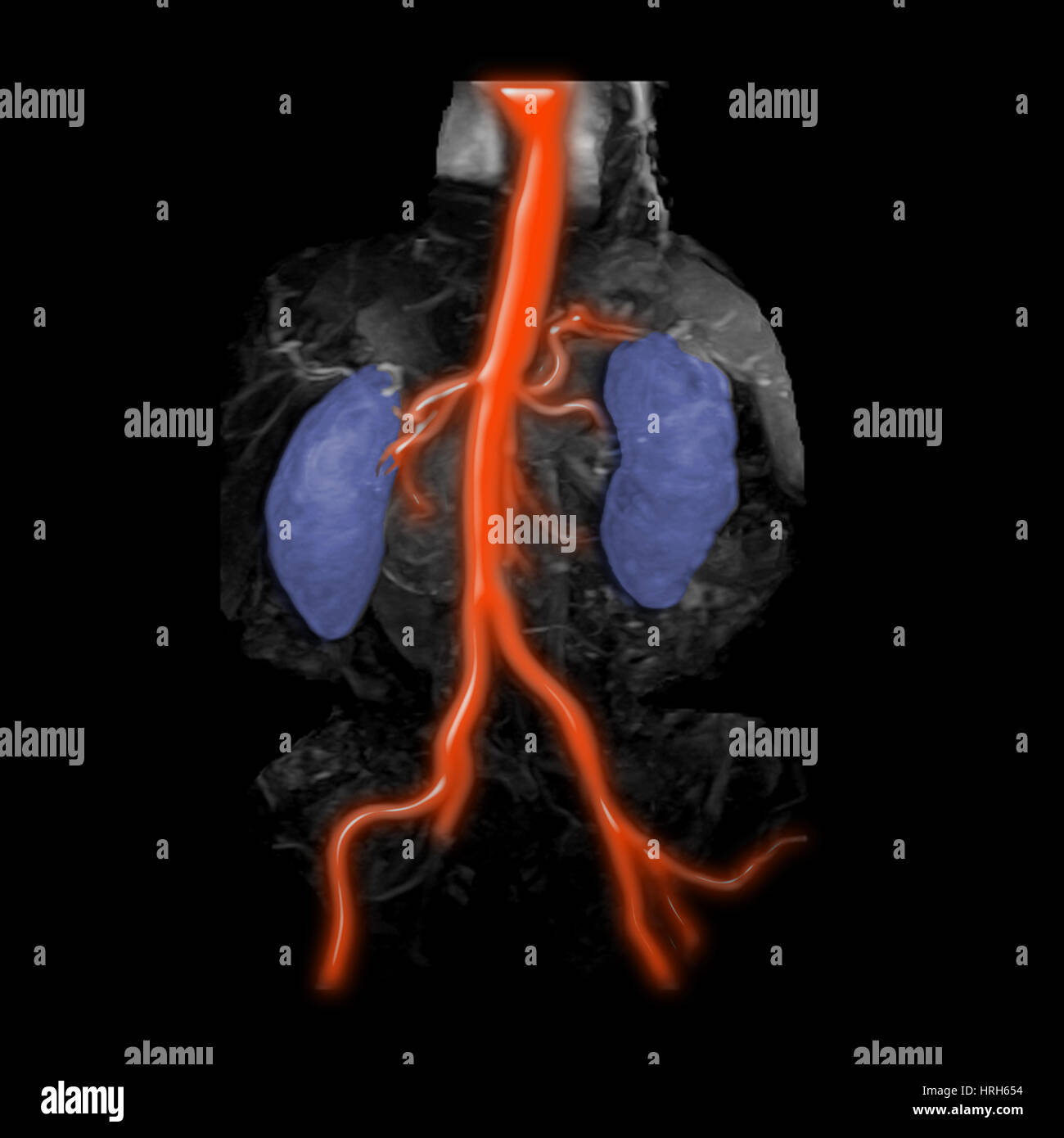 L'aorte abdominale, les reins et les artères iliaques Banque D'Images