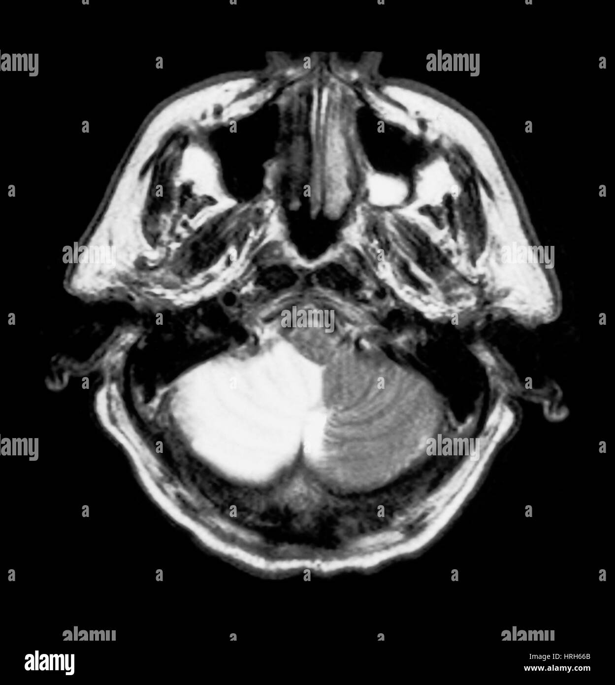 Accident vasculaire cérébral Banque D'Images
