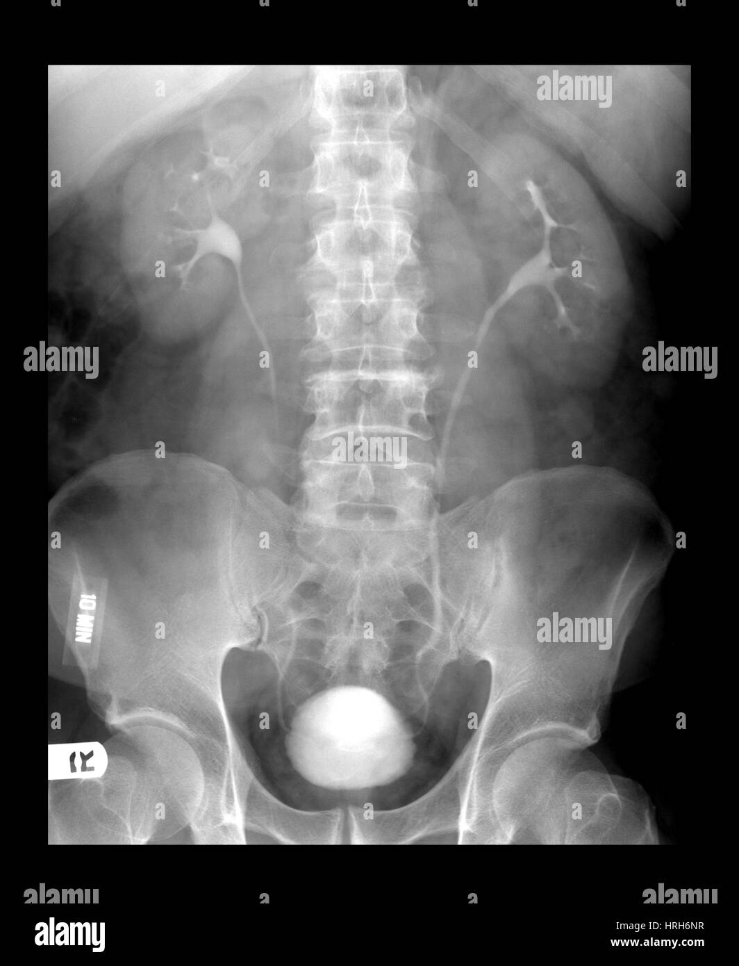 Rein Pyelo Radiolographie des reins Banque de photographies et d’images à haute ...