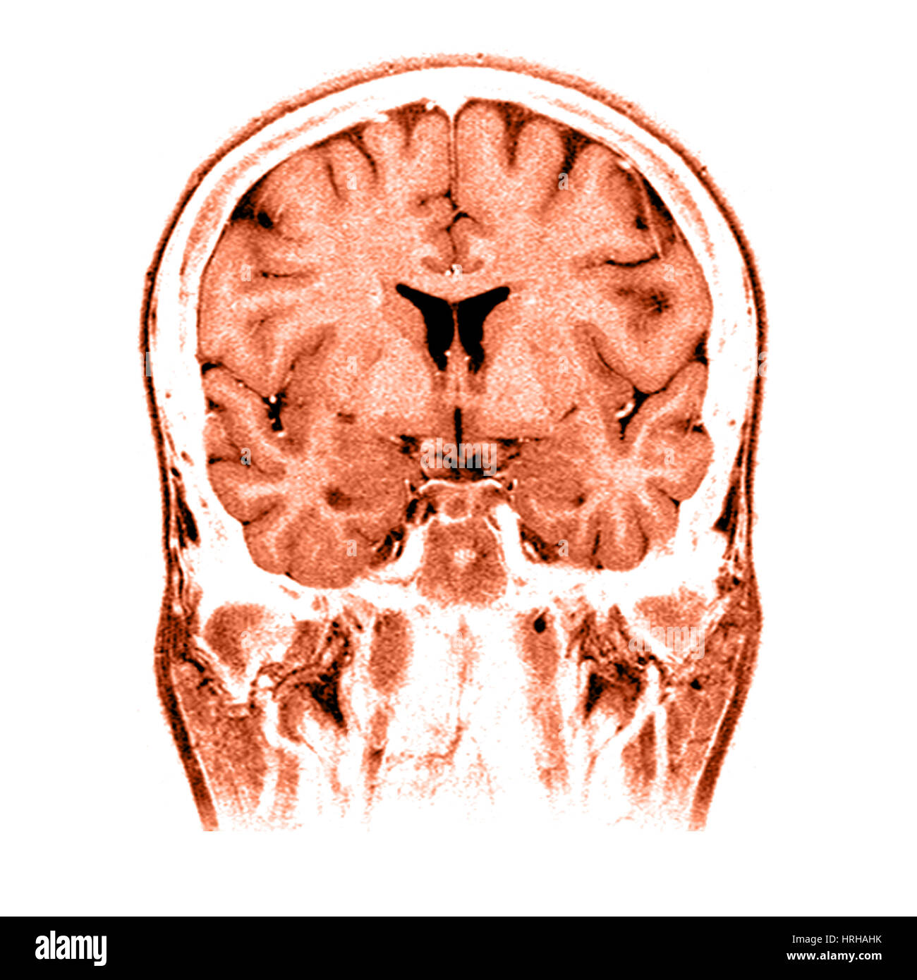 La normale du cerveau IRM coronale Banque D'Images