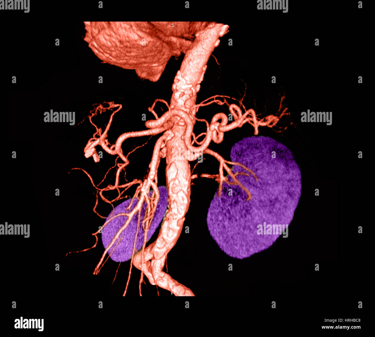 Aorte abdominale Banque D'Images