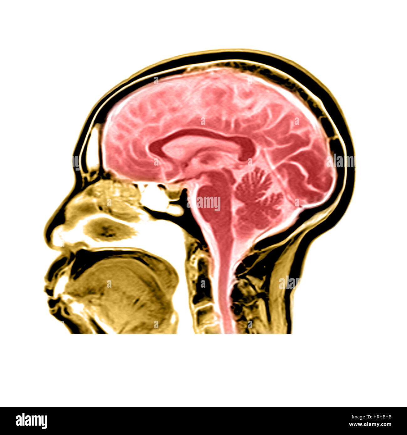 Vue sagittale d'une IRM du cerveau Banque D'Images