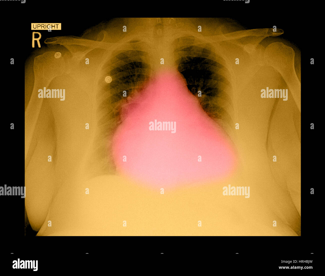 Hypertrophie du coeur sur la radiographie Banque D'Images