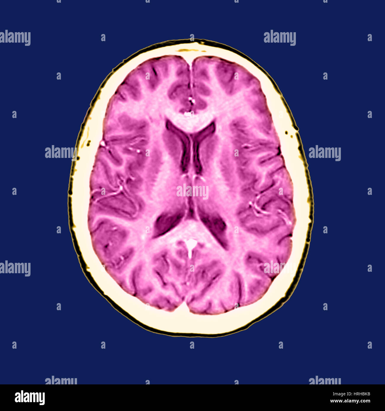 En Coupe Normal IRM du cerveau Banque D'Images