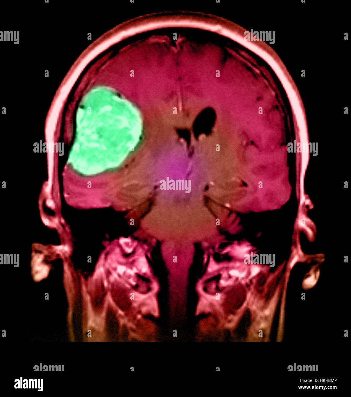 Tumeur Au Cerveau Meningiome Banque De Photographies Et D images 
