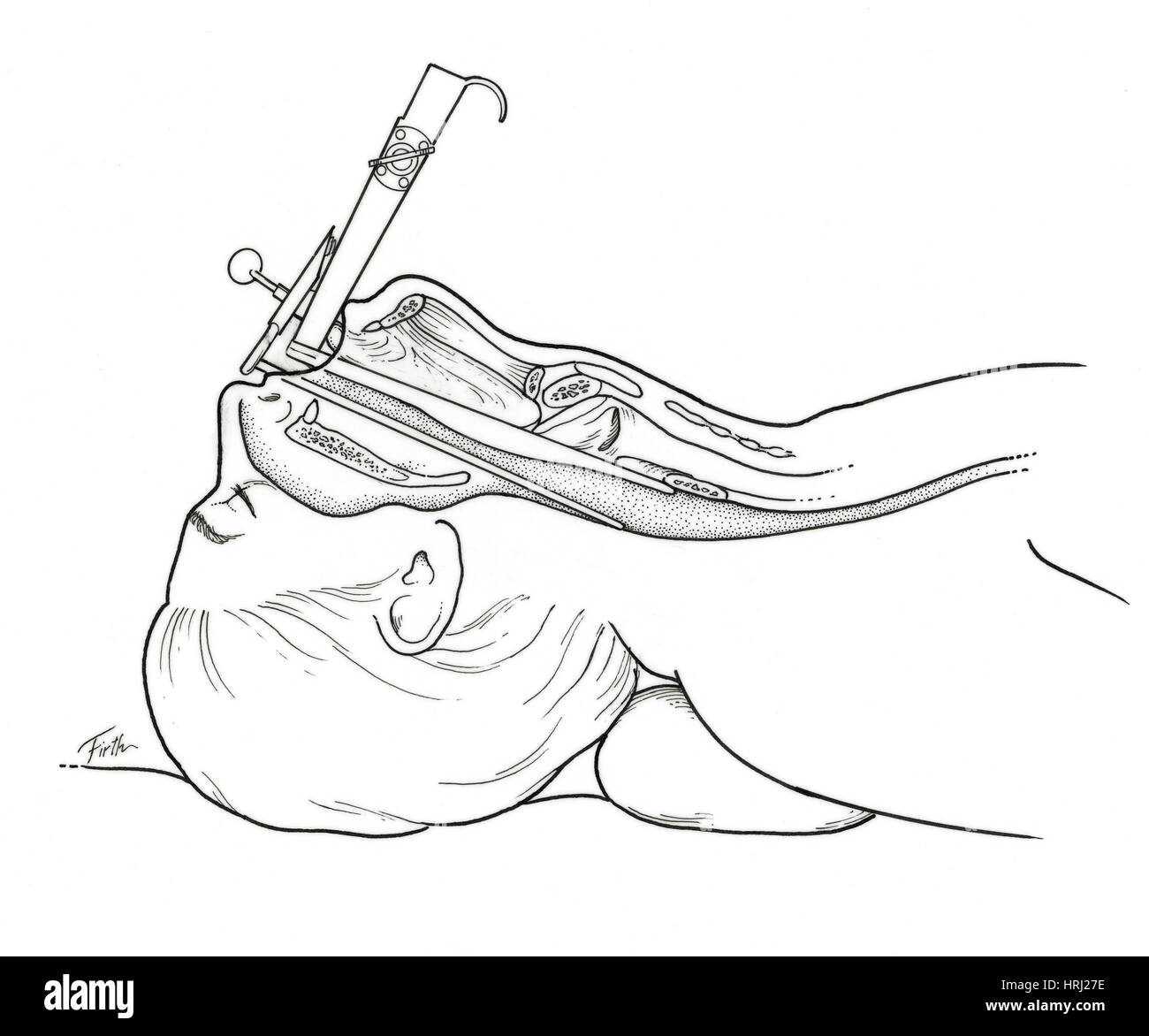 Illustration de la laryngoscopie Banque D'Images