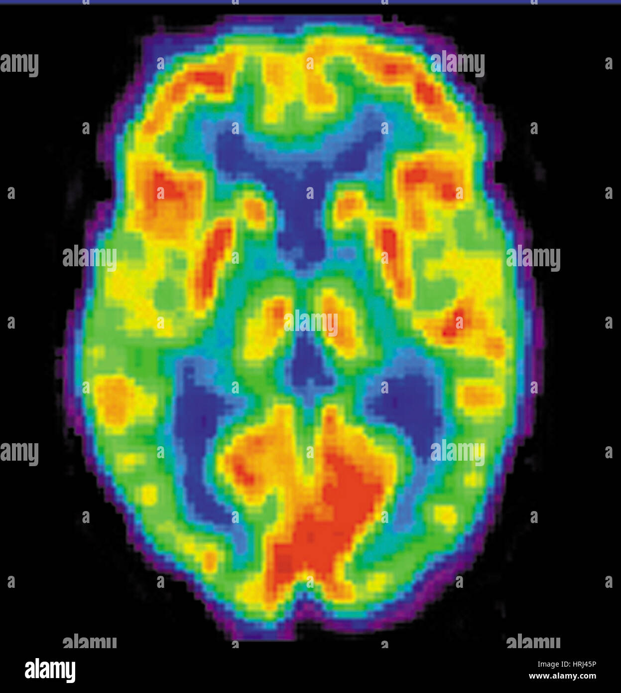 Image TEP du cerveau âgé de 20 ans, 1 de 2 Banque D'Images