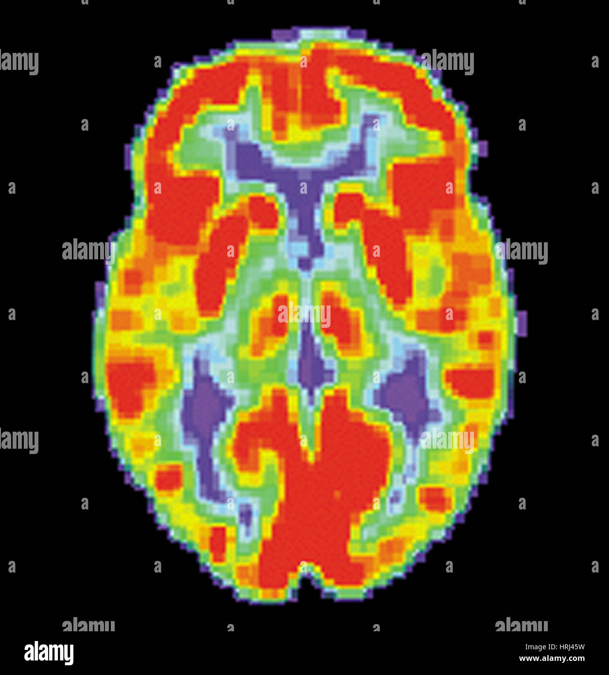 Image TEP du cerveau normal, 1 de 2 Banque D'Images