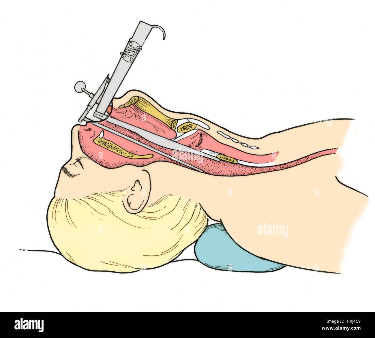Illustration de la laryngoscopie Banque D'Images