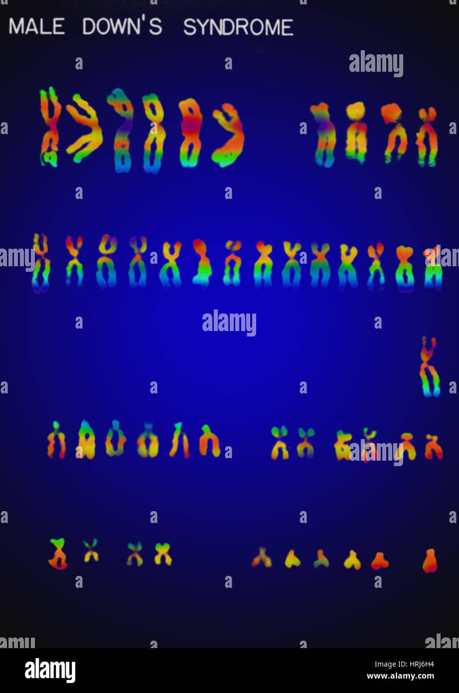 Le syndrome de caryotype Banque D'Images