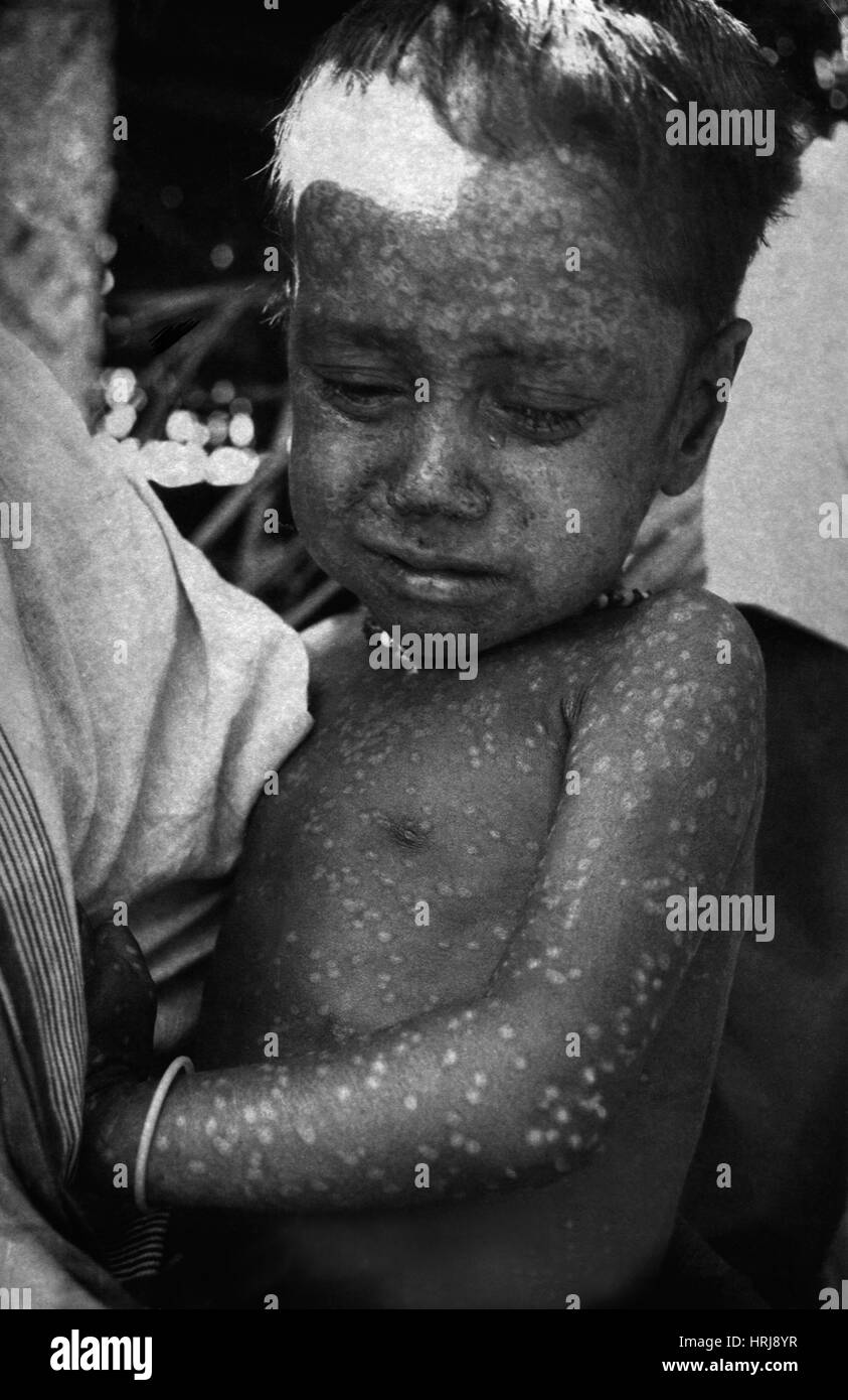 Dernier cas connu de variole Naturally-Occurring, 1975, 1 de 2 Banque D'Images