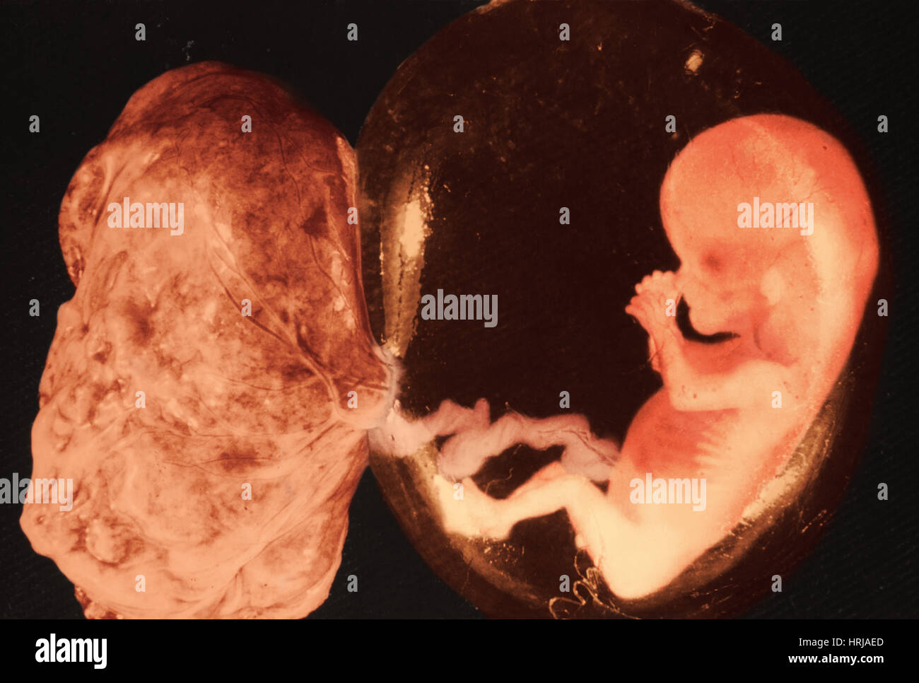 Les Foetus A 13 Semaines Photo Stock Alamy