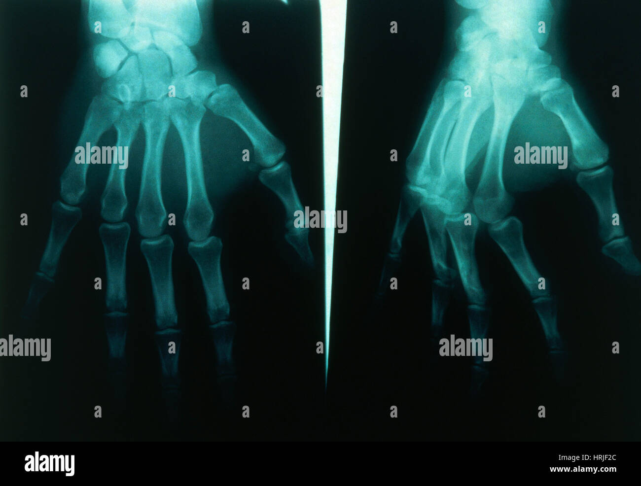 Main normale et arthritiques Banque D'Images