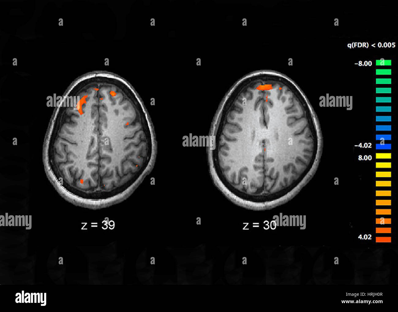 La schizophrénie, d'IRM Banque D'Images