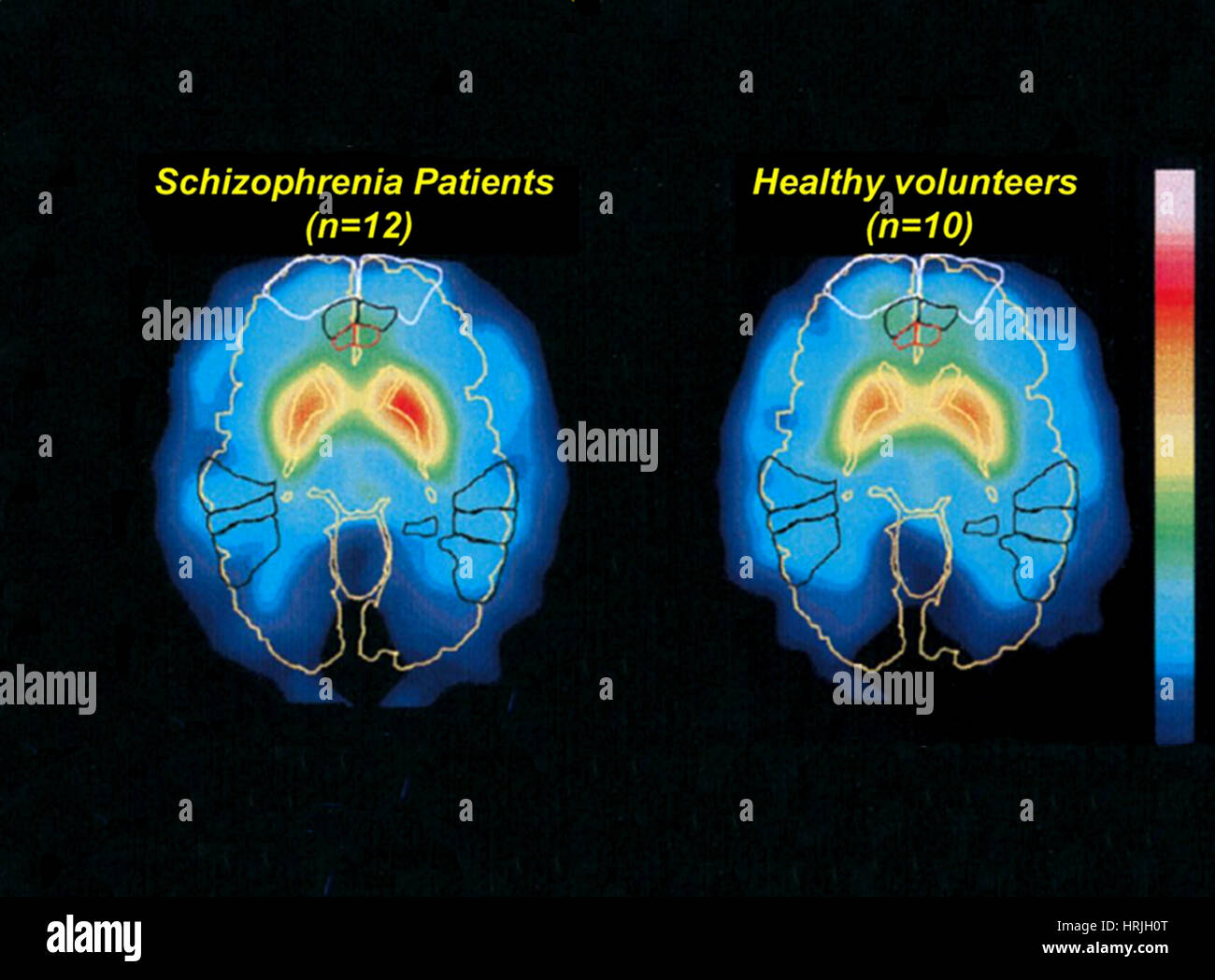 La schizophrénie et le fonctionnement normal du cerveau, la TEP Banque D'Images